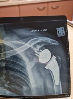 Reverse Shoulder.jpg